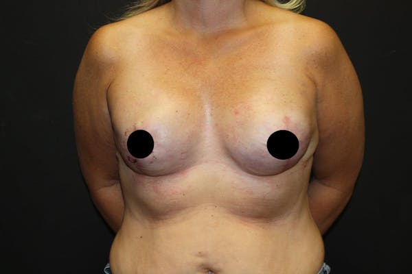 Breast Reconstruction Before & After Gallery - Patient 5799723 - Image 2