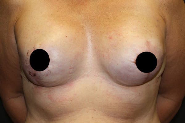 Breast Reconstruction Before & After Gallery - Patient 5799723 - Image 3