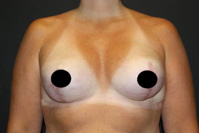 Breast Reconstruction Before & After Gallery - Patient 5799723 - Image 4