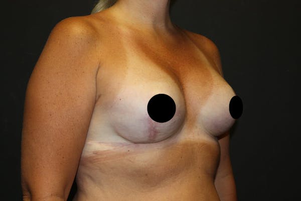 Breast Reconstruction Before & After Gallery - Patient 5799723 - Image 5
