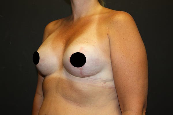 Breast Reconstruction Before & After Gallery - Patient 5799723 - Image 6