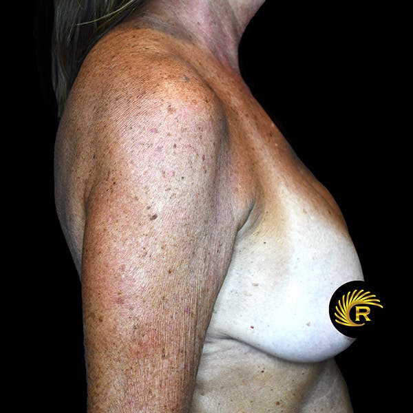 Breast Lift Before & After Gallery - Patient 148814 - Image 3