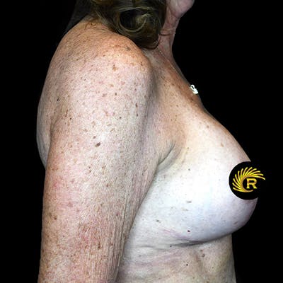 Breast Lift Before & After Gallery - Patient 148814 - Image 4
