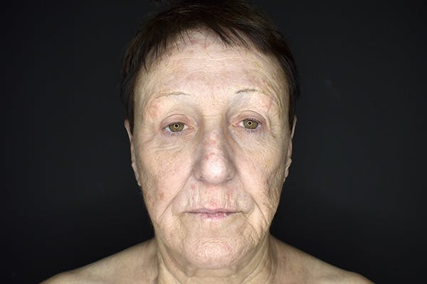 Facelift Before & After Gallery - Patient 383349 - Image 1