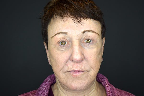 Facelift Before & After Gallery - Patient 383349 - Image 2