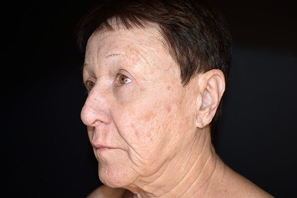 Facelift Before & After Gallery - Patient 383349 - Image 3