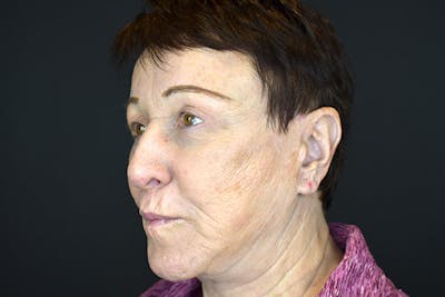 Facelift Before & After Gallery - Patient 383349 - Image 4