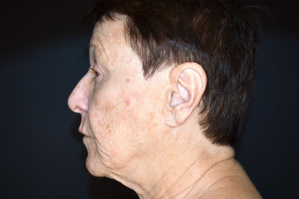 Facelift Before & After Gallery - Patient 383349 - Image 5
