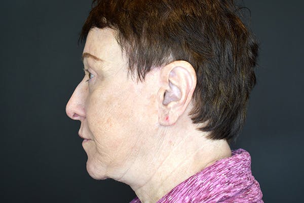 Facelift Before & After Gallery - Patient 383349 - Image 6