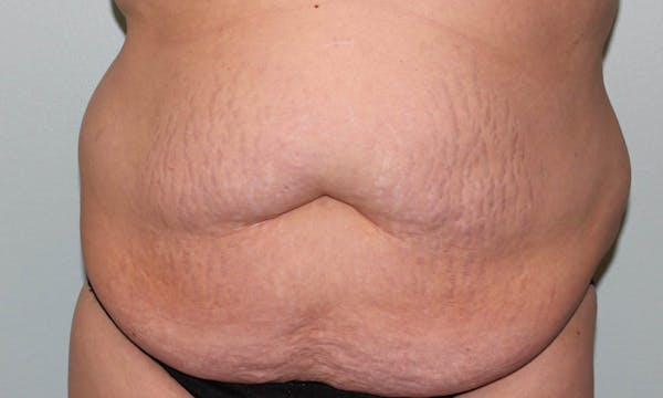 Tummy Tuck (Abdominoplasty) Before & After Gallery - Patient 5794629 - Image 1