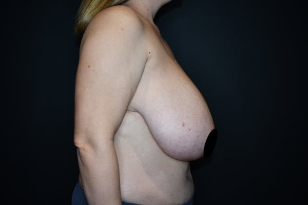 Breast Reduction Before & After Gallery - Patient 148539127 - Image 5