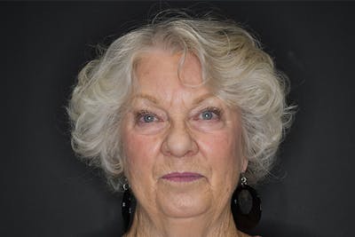 Facelift Before & After Gallery - Patient 251367 - Image 1
