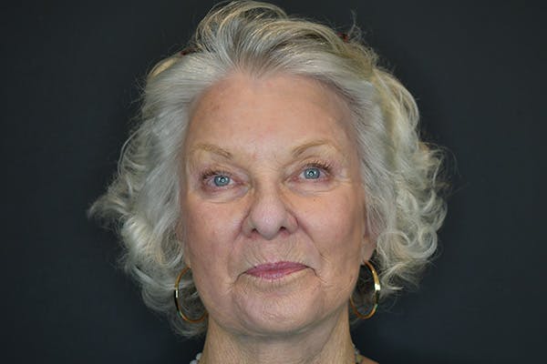 Facelift Before & After Gallery - Patient 251367 - Image 2