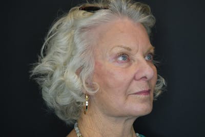 Facelift Before & After Gallery - Patient 251367 - Image 4