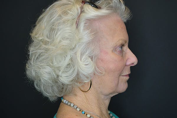 Facelift Before & After Gallery - Patient 251367 - Image 6