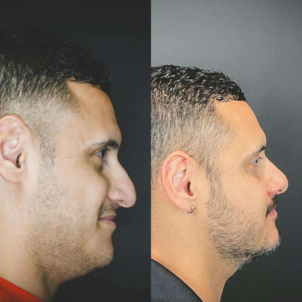 Rhinoplasty Before & After Gallery - Patient 174095061 - Image 2
