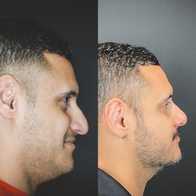 Rhinoplasty Before & After Gallery - Patient 174095061 - Image 2