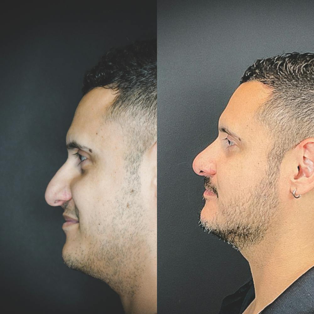Rhinoplasty Before & After Gallery - Patient 174095061 - Image 1
