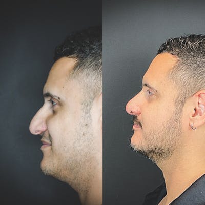 Rhinoplasty Before & After Gallery - Patient 174095061 - Image 1