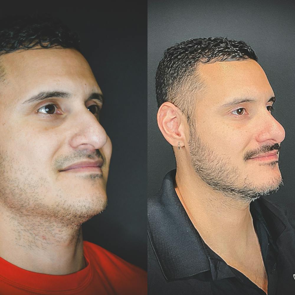 Rhinoplasty Before & After Gallery - Patient 174095061 - Image 3