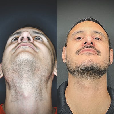 Rhinoplasty Before & After Gallery - Patient 174095061 - Image 4