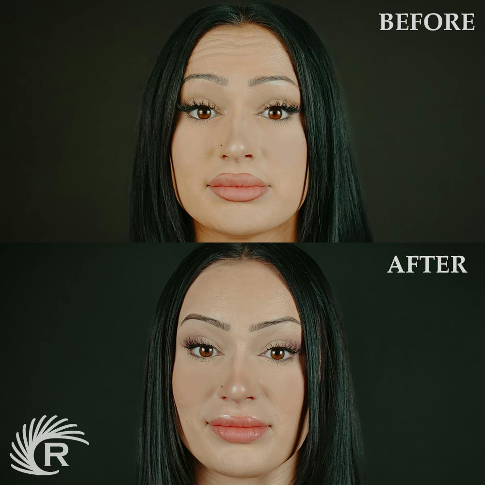 Botox Before & After Gallery - Patient 317464 - Image 2