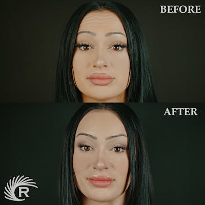 Botox Before & After Gallery - Patient 317464 - Image 2