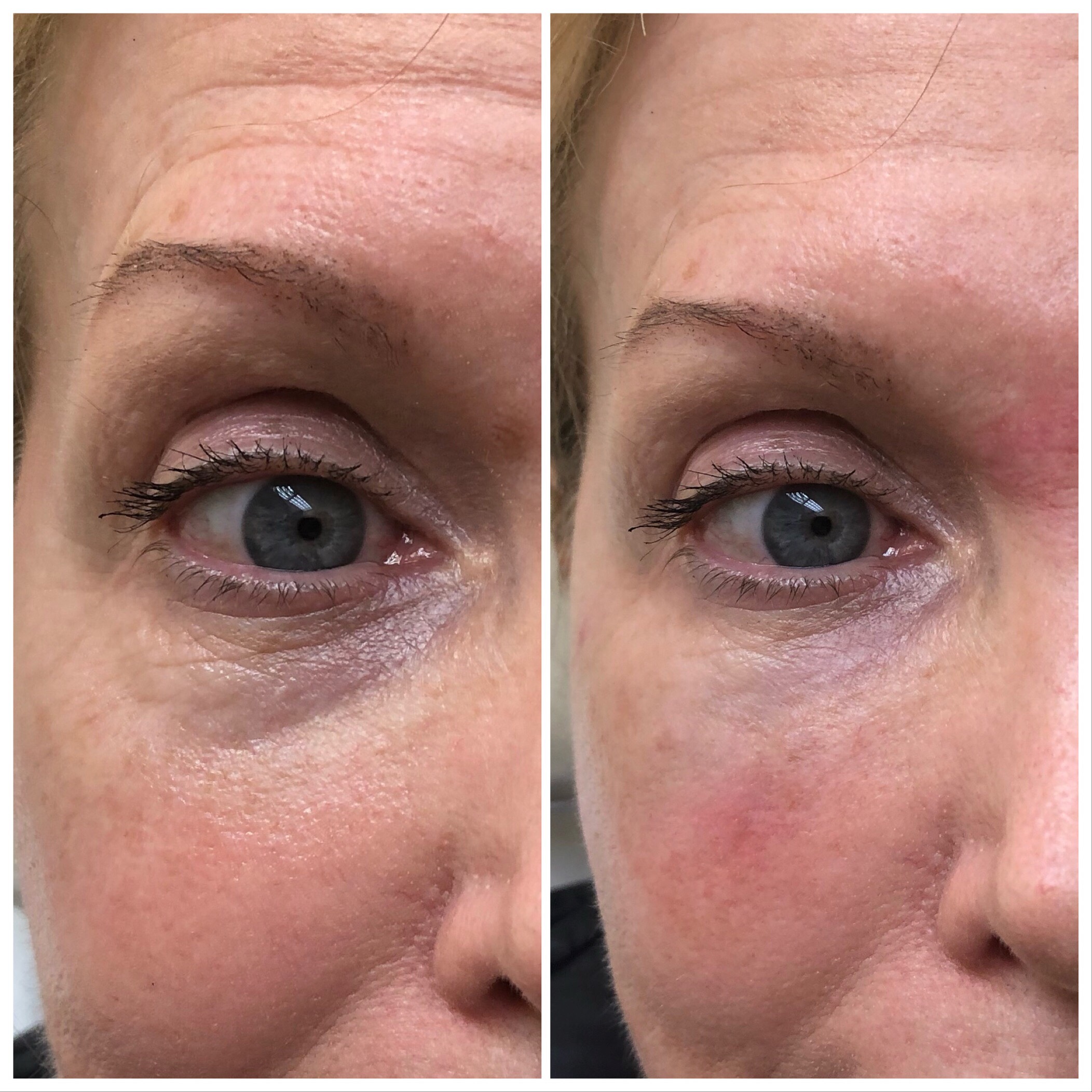 B&A Under Eye Filler Gallery | Dr. Hardik Doshi in Brooklyn