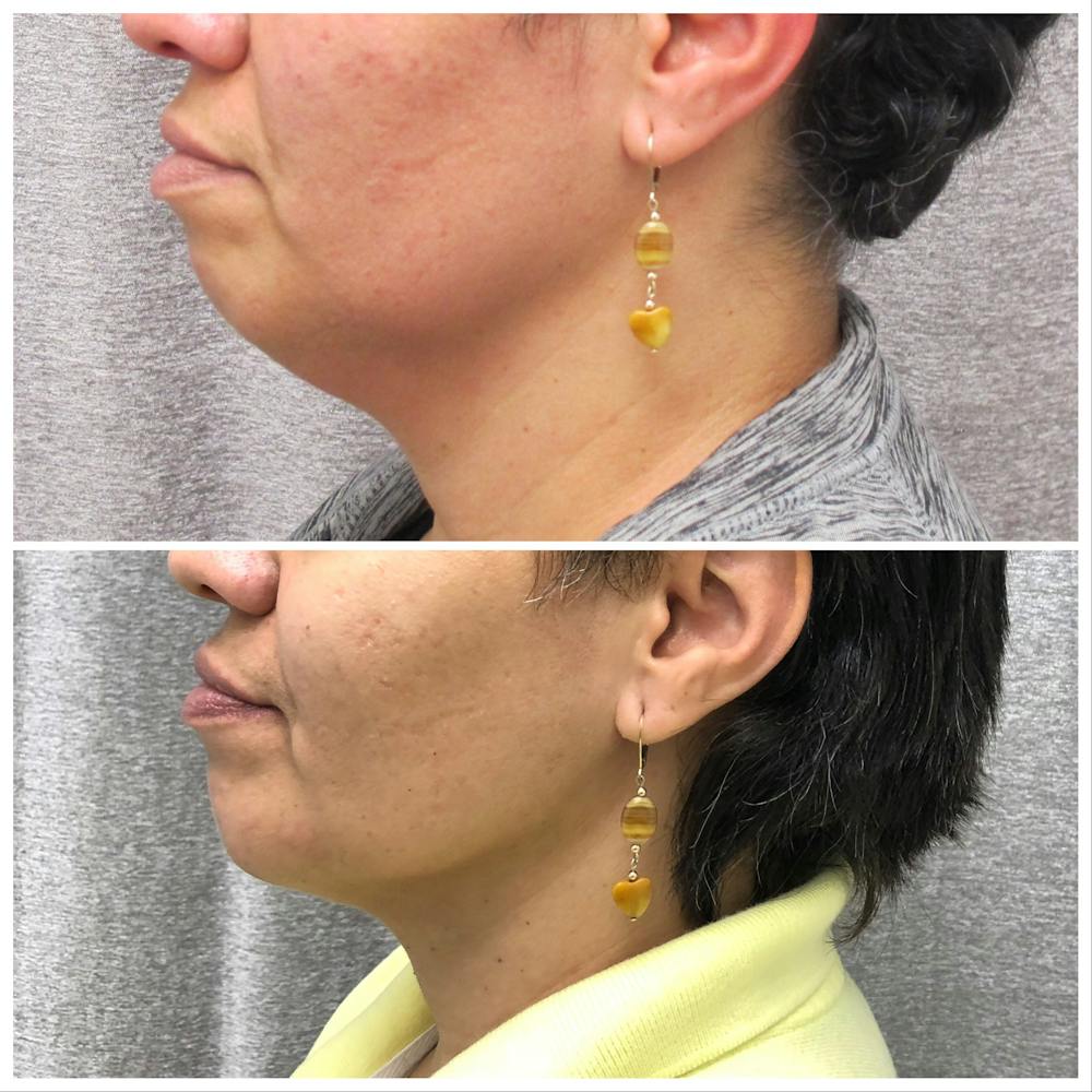 Chin Augmentation