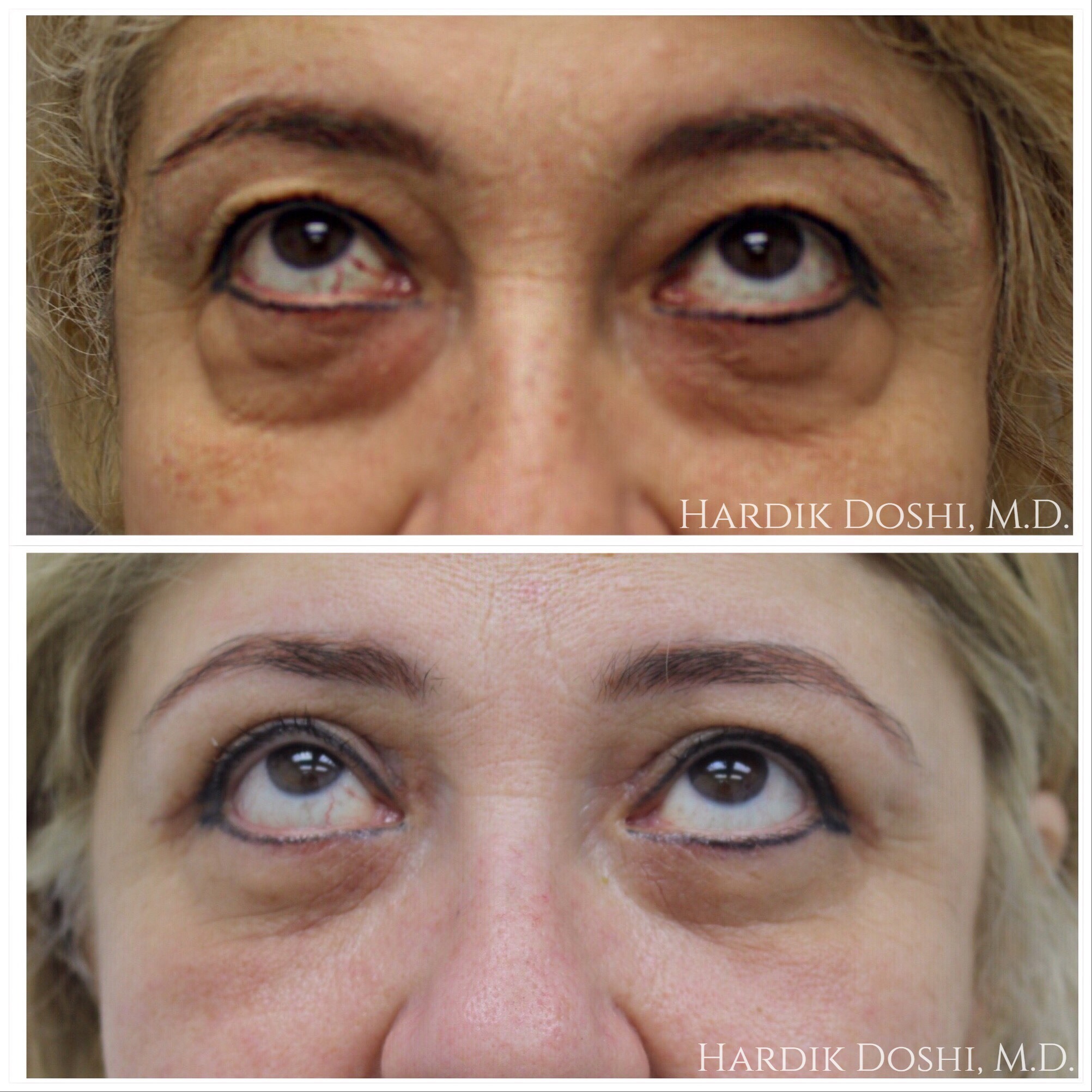 Female Eyelid Surgery in Brooklyn Before & After Photos by Dr. Doshi