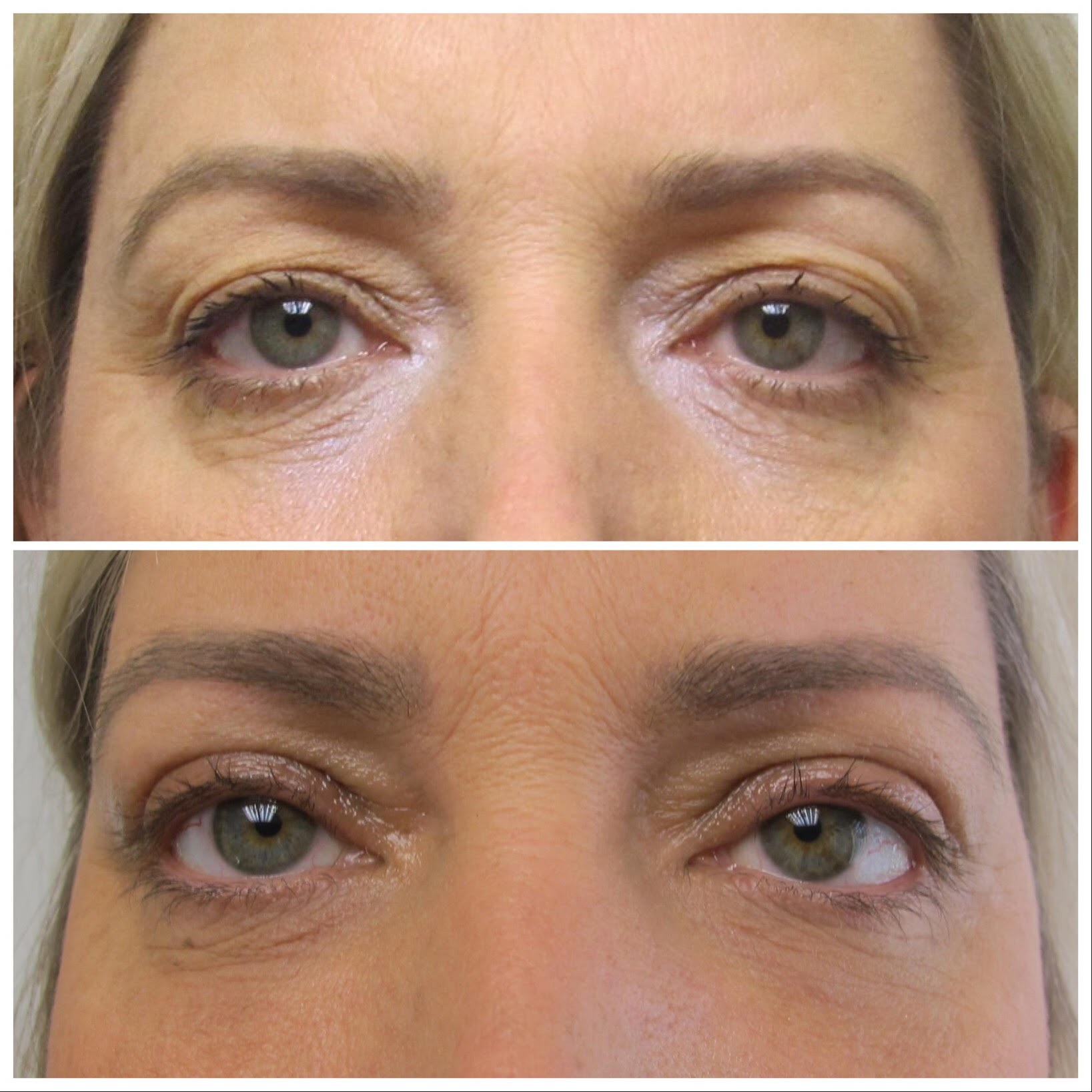 Before & After Eyelid Surgery With Dr. Doshi 02