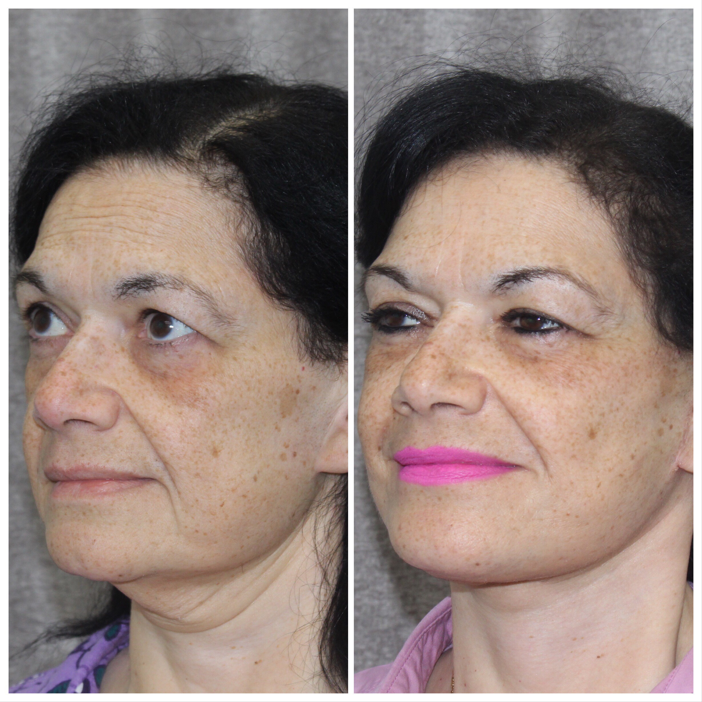 Before and After of Neck Lift in Long Island with Dr. Doshi