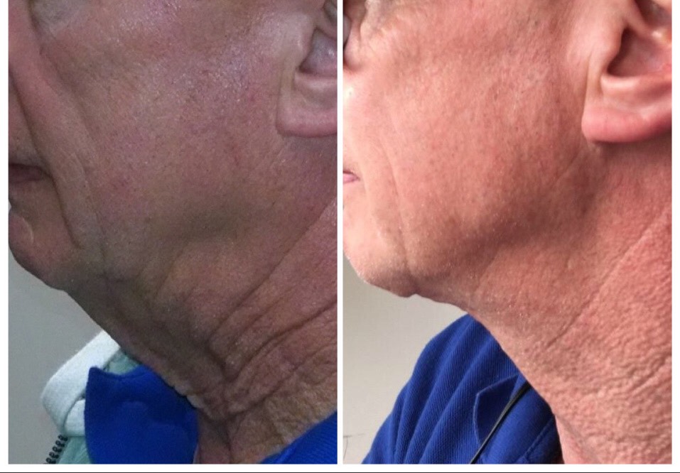 Before and After of Best Neck Lift in Brooklyn with Dr. Doshi