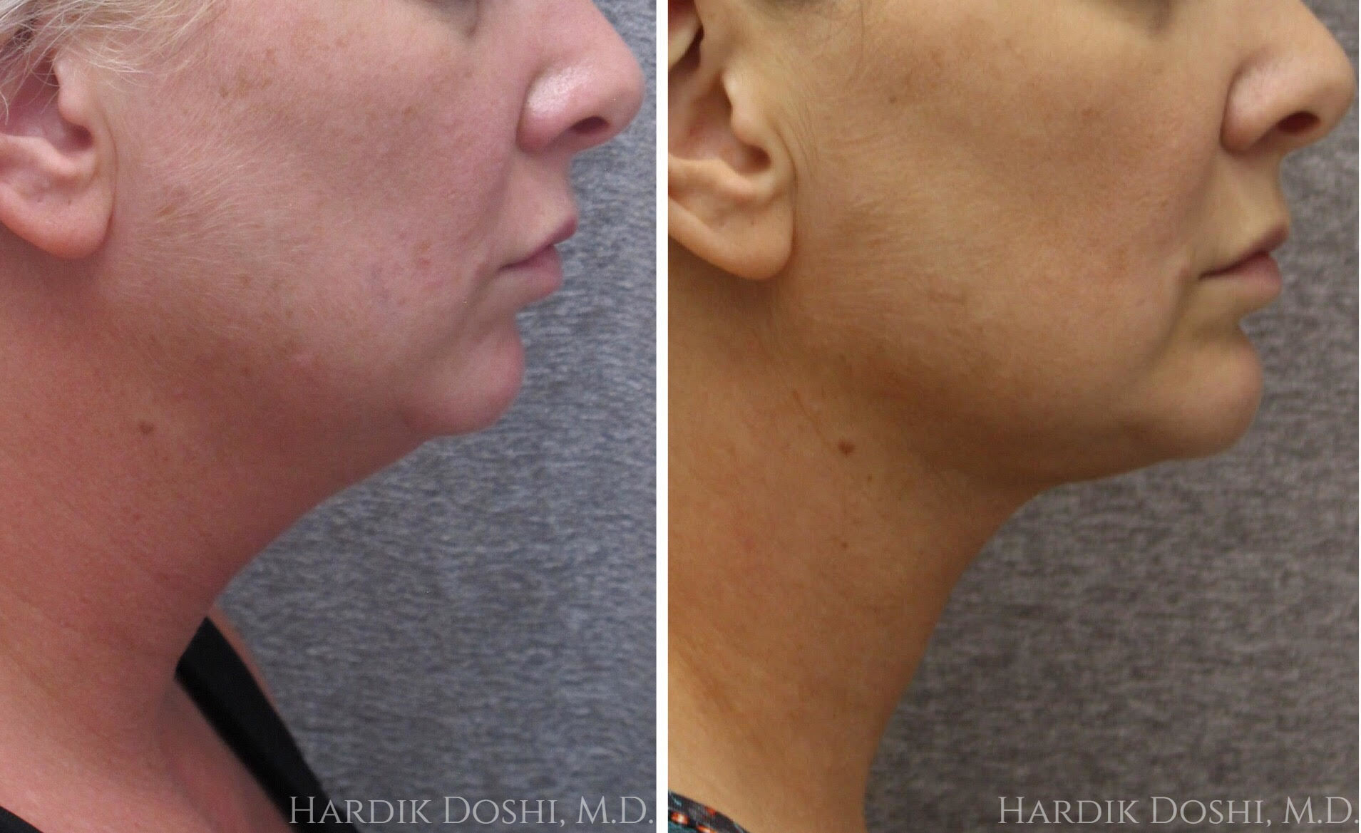 Before and After of Best Neck Lift in Long Island with Dr.Doshi