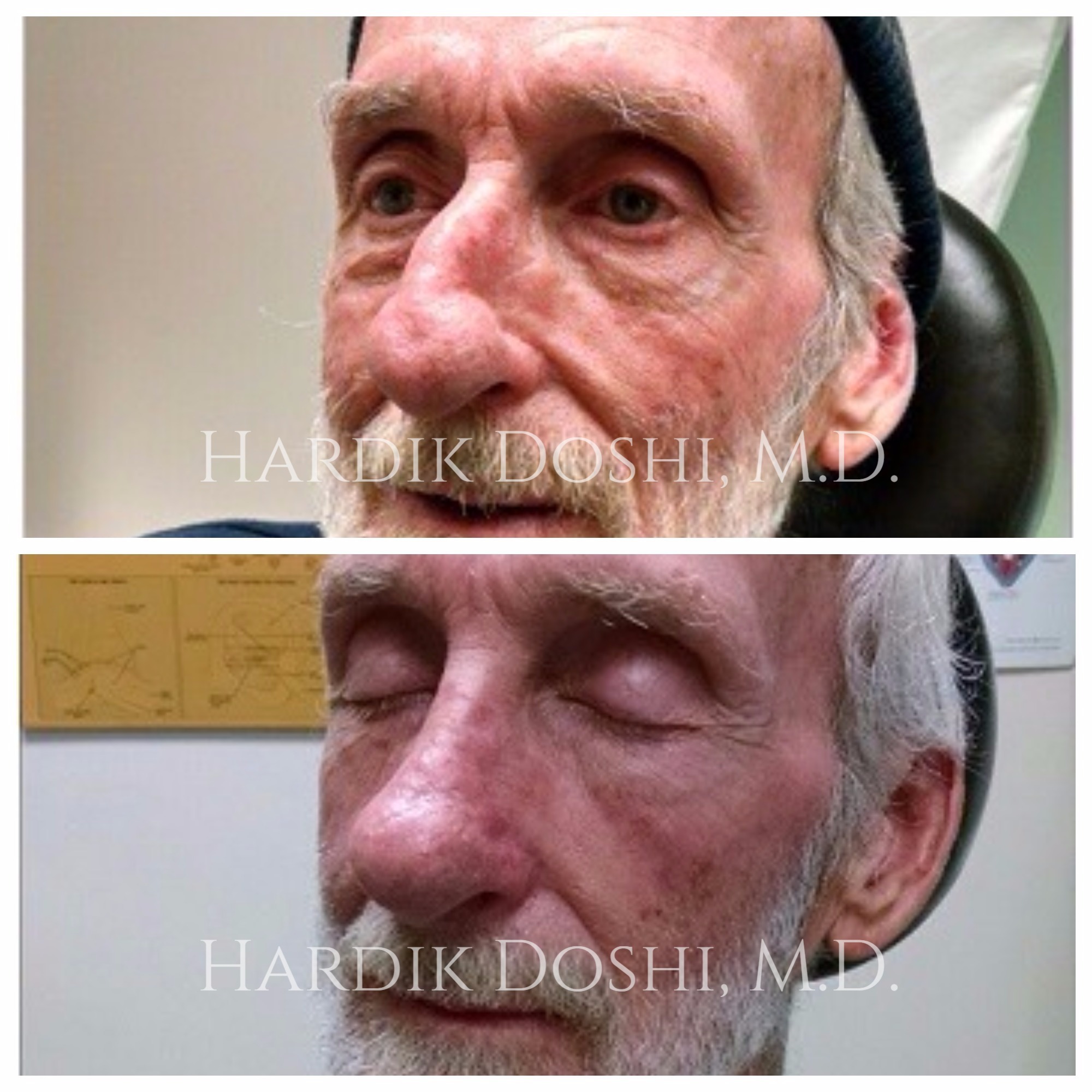 Before and After of Rhinoplasty in Long Island with Dr. Doshi