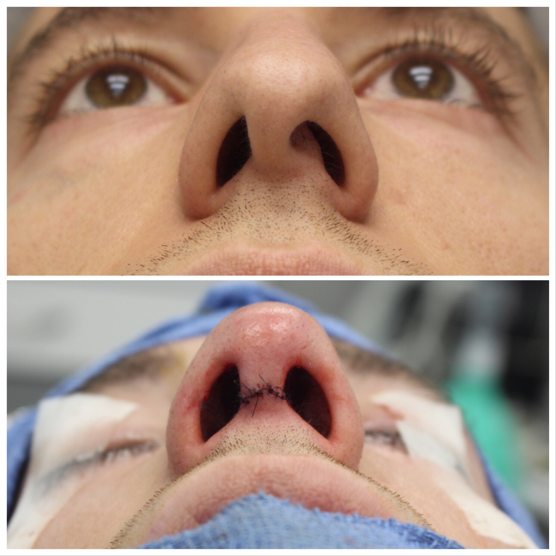 Before and After of Nose Job in Brooklyn with Dr. Doshi