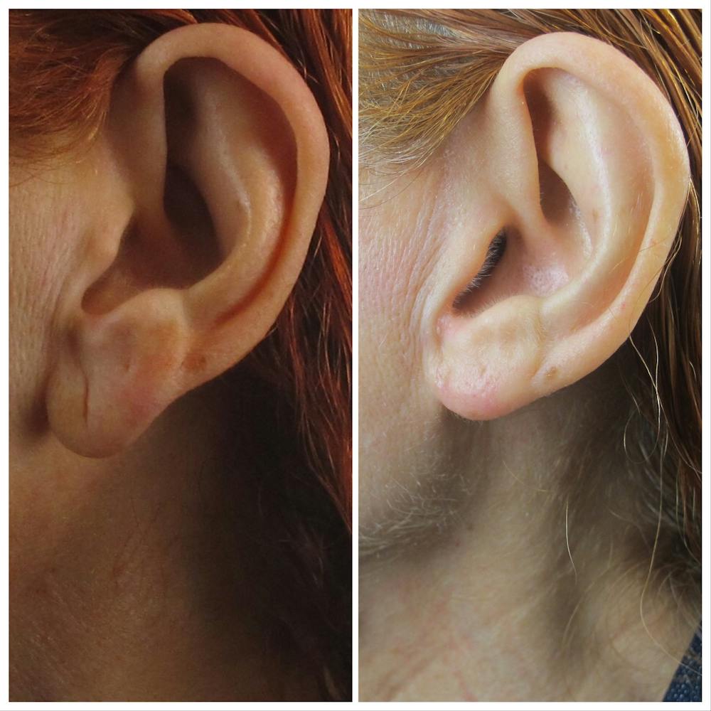 Chao Plastic Surgery - Earlobe filler! It's a perfect, nonsurgical repair  for saggy earlobes. Earrings hanging? Earlobes stretched out? Make an  appointment today! ✨ No downtime. Lasts 1+ years