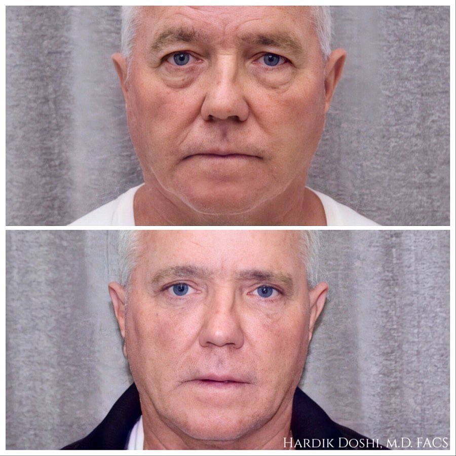 Male Eyelid Surgery in Brooklyn Before & After Photos by Dr. Doshi
