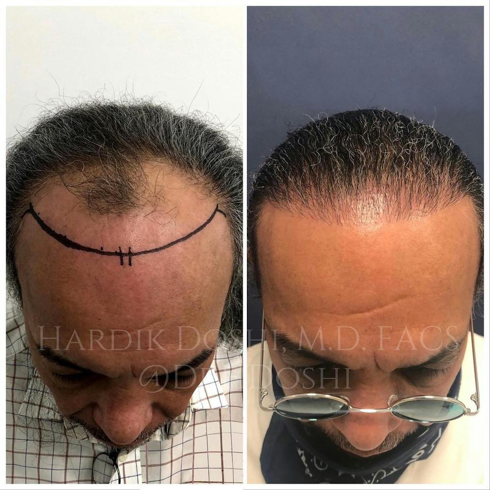 Hair Restoration Gallery - Patient 37533684 - Image 1