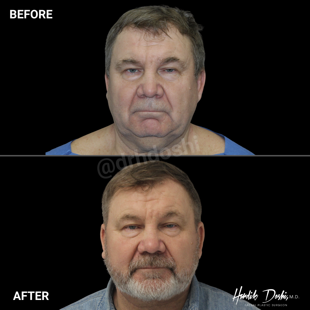 Dr. Doshi Male Facelift Before & After Photo - Front Angle