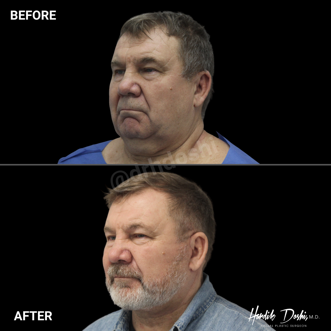 Dr. Doshi Male Facelift Before & After Photo - Side Angle