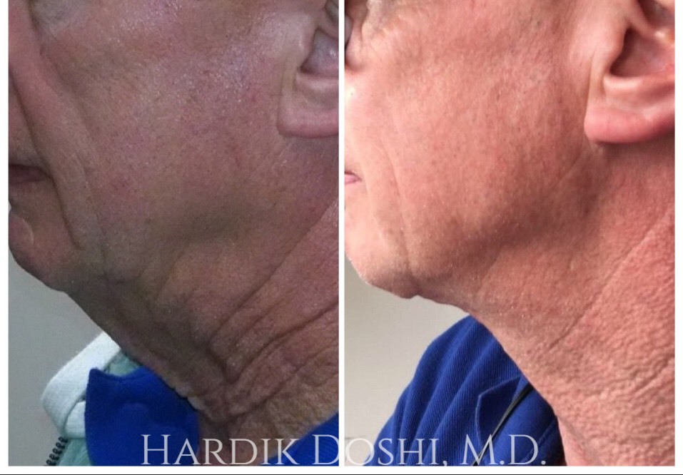 Dr. Doshi Male Facelift & Neck Lift Before & After Photo