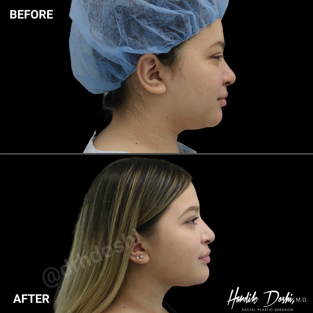 Before & after facial liposuction photos
