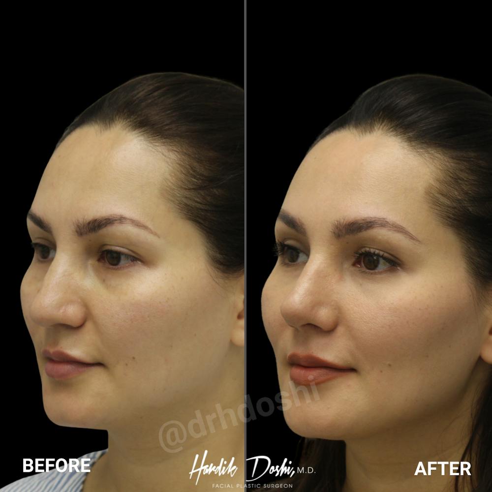 Partial profile view of before and after Rhinoplasty by Dr. Doshi