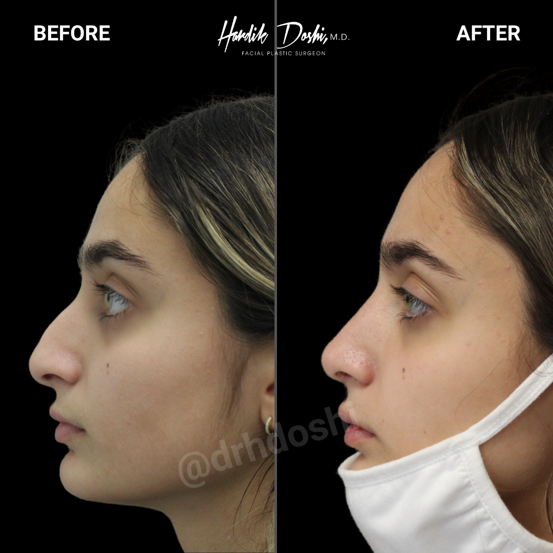 Rhinoplasty Long Island  Nose Job in Long Island