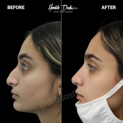Profile view of before and after Rhinoplasty by Dr. Doshi