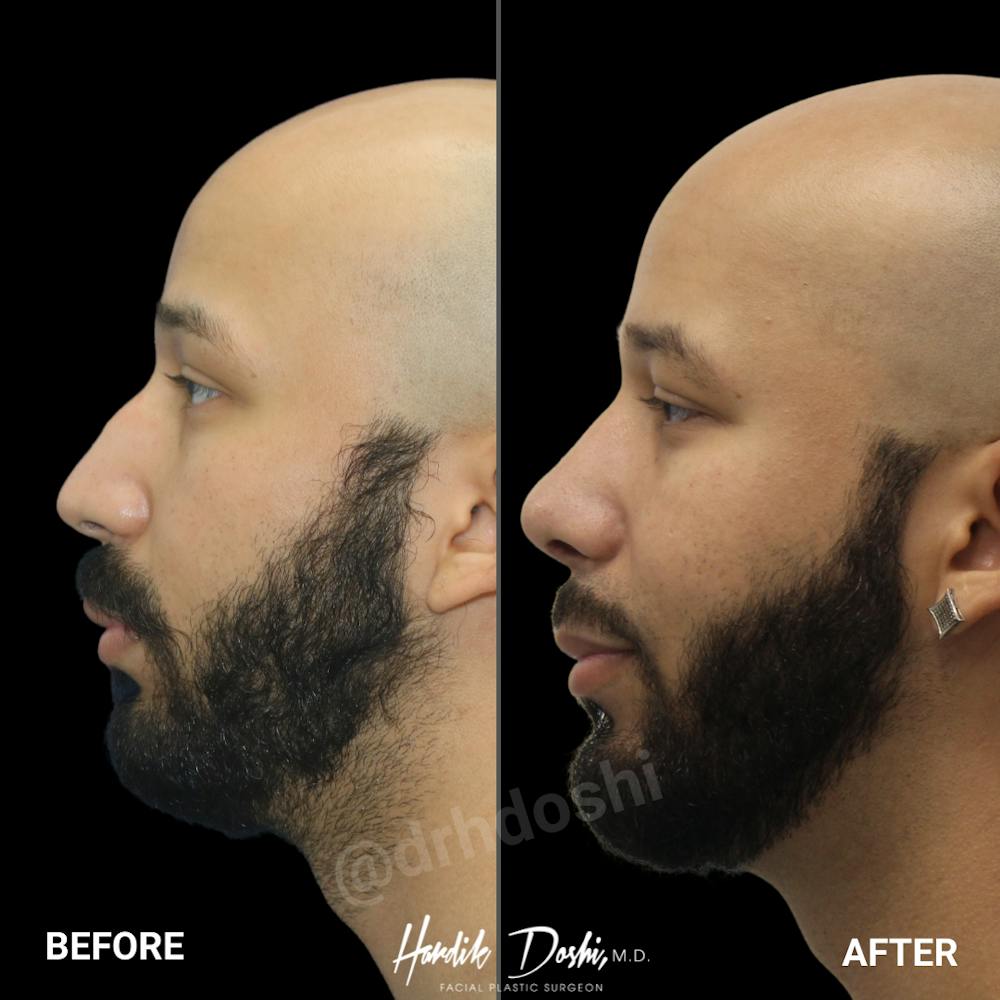 Profile view of before and after Male Rhinoplasty by Dr. Doshi
