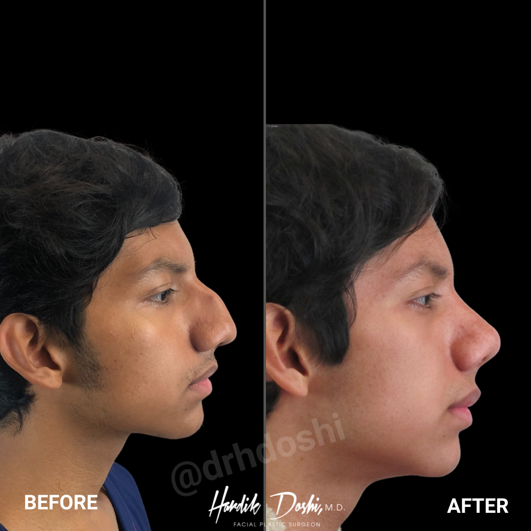 Rhinoplasty