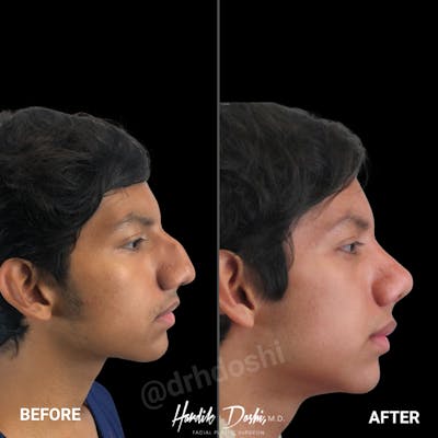 Profile view of before and after Young Male Rhinoplasty by Dr. Doshi
