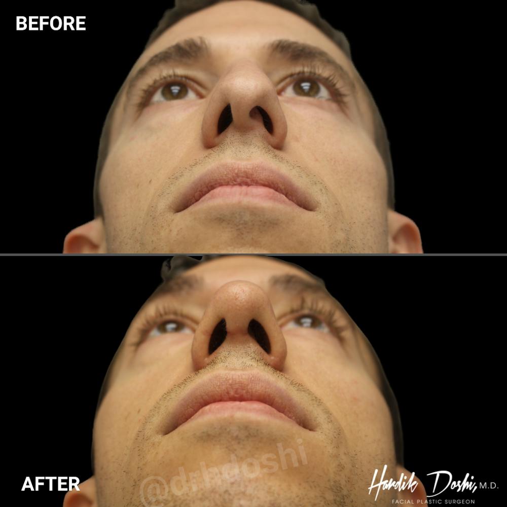 Upward angle of before and after rhinoplasty by Dr. Doshi, showing aligned septum